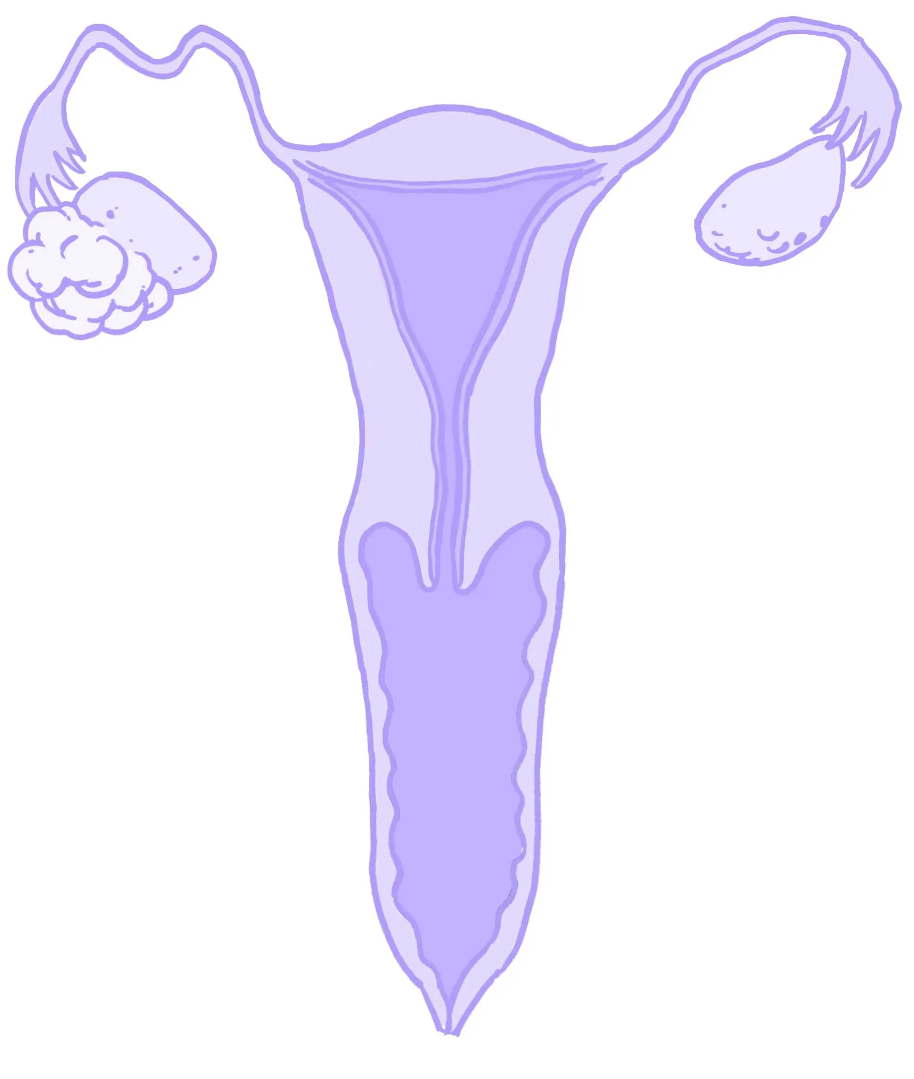 Illustration av äggstockscancer, av Hormonology.