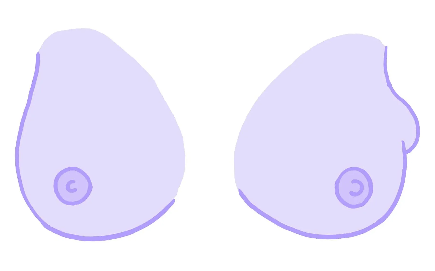 Illustration av bröstcancer, av Hormonology.