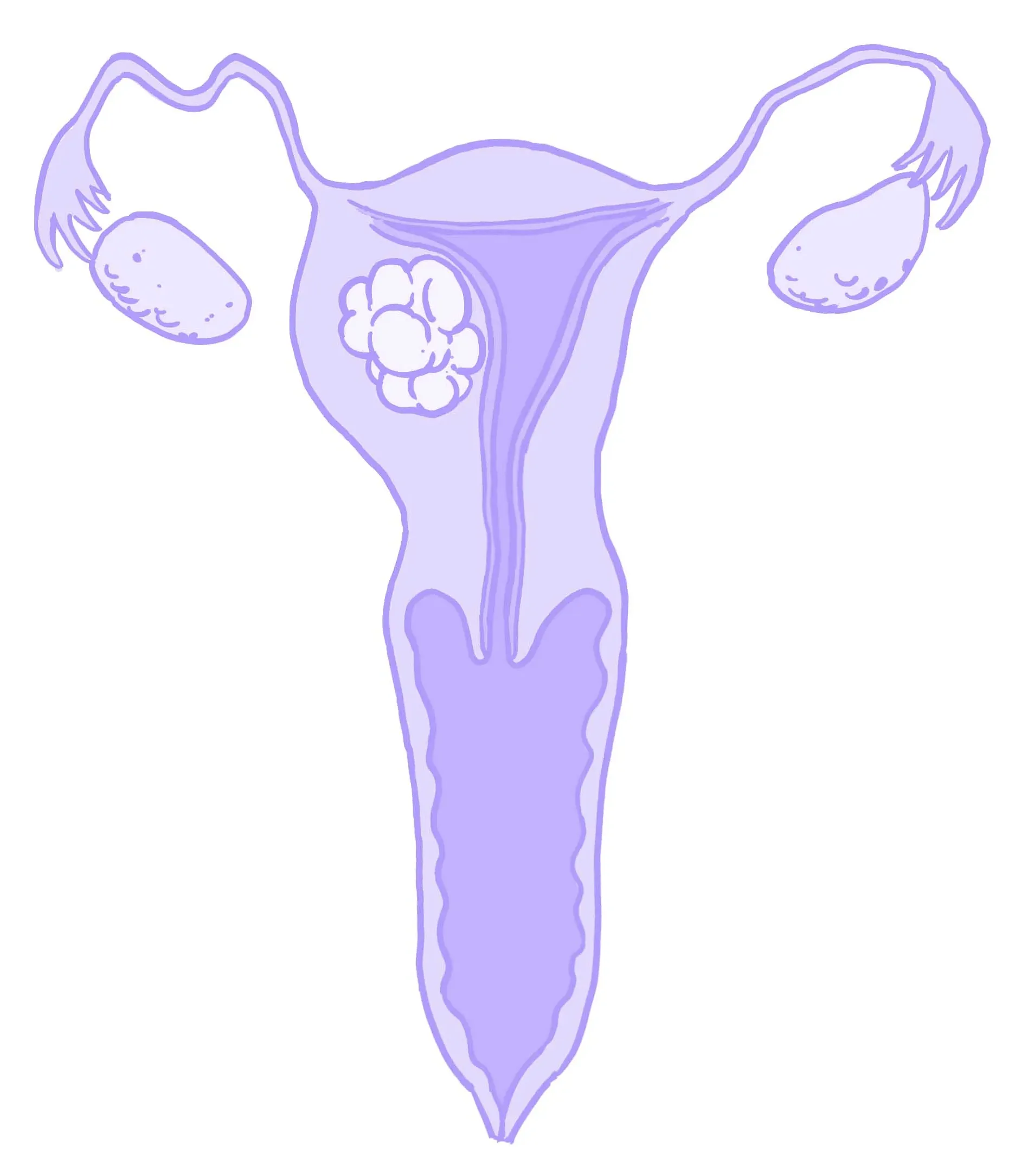 Illustration av livmodercancer, av Hormonology.